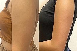 Barbie Arms with Botox Cost in Dubai UAE