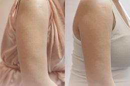 Barbie Arms with Botox in Dubai & Abu-Dhabi