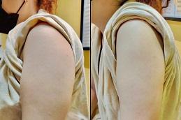 Barbie Arms with Botox in Dubai UAE