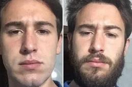 Beard Hair Transplant Clinic In Dubai