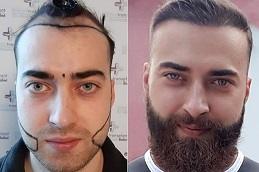 Beard Hair Transplant Cost in Dubai & Abu Dhabi