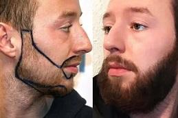 Beard Hair Transplant in Dubai