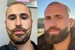 Beard Hair Transplant in Dubai Abu Dhabi