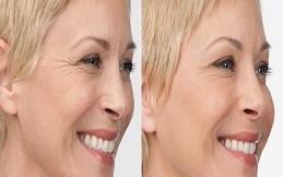 Best Allergan Botox Dubai & Abu Dhabi 