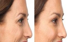 Best Allergan Botox before & After