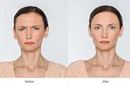 Best Allergan Botox before & After