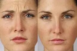 Best Allergan Botox before & After