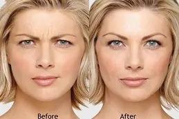 Best Allergan Botox clinic in Dubai