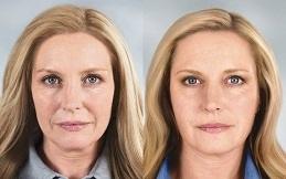 Best Allergan Botox in Dubai & Abu Dhabi