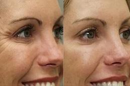 Best Aqualyx Injection Clinic in Dubai