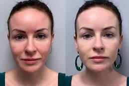 Best BB Glow Treatment Dubai Abu Dhabi