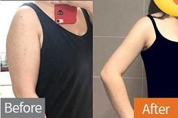 Best Barbie Arms with Botox Dubai Abu Dhabi