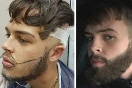 Best Beard Hair Transplant Clinic in Dubai