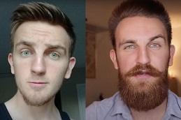 Best Beard Hair Transplant in Dubai & Abu Dhabi
