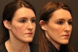 Best Cheek Fillers Injections Clinic in Dubai