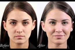 Best Cheek Fillers Injections in Dubai & Abu-Dhabi