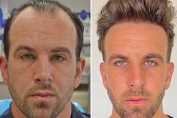 Best FUE Hair Transplant in Dubai Abu Dhabi