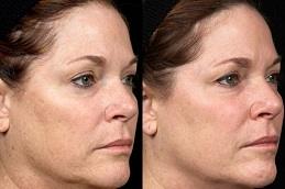 Best Facial Treatment in Dubai UAE Abu Dhabi