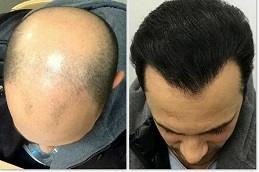Best Fue Hair Transplant Clinic in Dubai