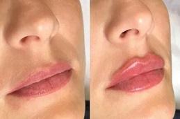 Best Juvederm Fillers Clinic in Dubai