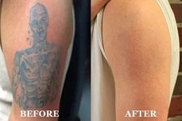 Permanent Laser Tattoo Removal