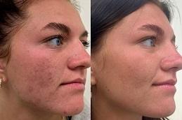 Microneedling with PRP Therapy in Dubai