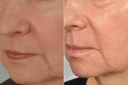 Best Microneedling Treatment Clinic in Dubai