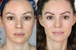 Best Microneedling Treatment In Dubai Abu Dhabi