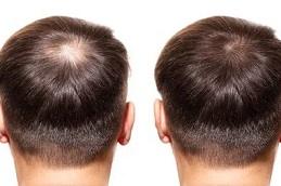 Best PRP Hair Treatment Clinic in Dubai