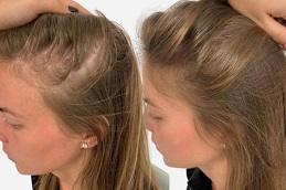 Best PRP Hair Treatment in Dubai Abu Dhabi
