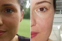 Best Permanent Skin Whitening Treatment Clinic in Dubai 1