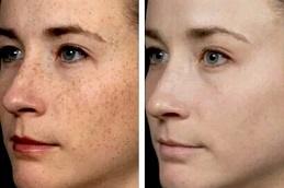 Pico Laser Treatment in Dubai & Abu Dhabi