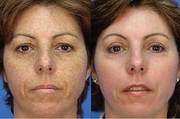 Pico Laser Treatment