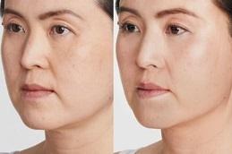 Best Ultherapy in Dubai Abu Dhabi