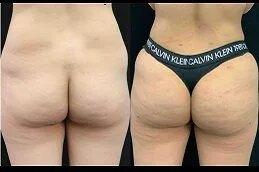 Body Fillers before after