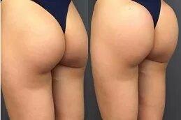 Body Fillers before after