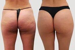 Body Fillers before after