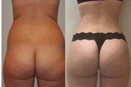 Body Fillers in Dubai uae