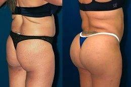 Body Fillers in Dubai