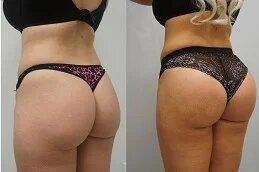 Body Fillers uae