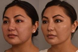 Buccal Fat Removal in Dubai