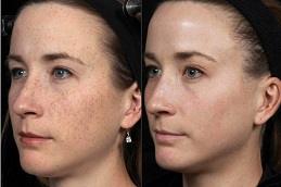 Cheap Facial Treatment in Dubai Abu Dhabi