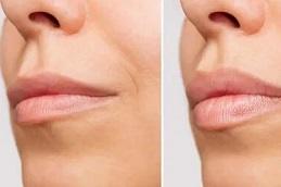  Fillers Injections Dubai