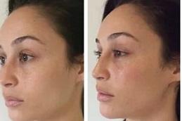  Cheek Fillers Injections Clinic in Dubai