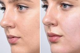 Cheek Fillers Injections in Dubai