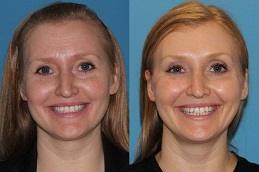  Cheek Fillers Injections in Dubai Abu Dhabi