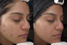 Chemical Peels in Dubai Abu Dhabi