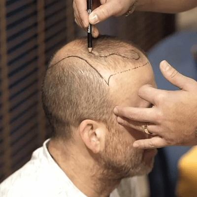 DHI Direct Hair Implants in Dubai & Abu Dhabi