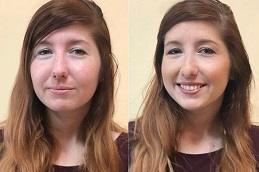 Deep Cleansing Facial Cost in Dubai Abu Dhabi 1