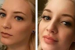 Dermal Fillers in Dubai